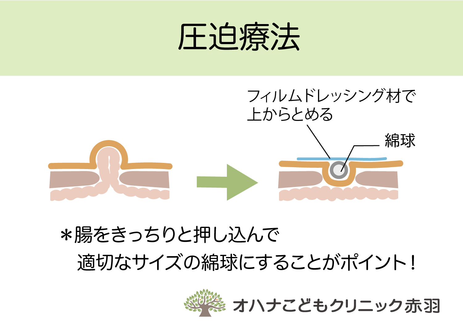 臍ヘルニアに伴う合併症はありますか?
